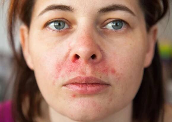 Periorální dermatitida — proč vzniká a jak léčit její projevy?
