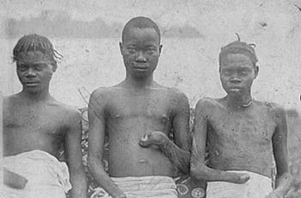 Congo Amputations