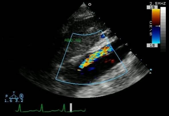 Elektrokardiogram vs Echokardiogram: Rozdíl a srovnání
