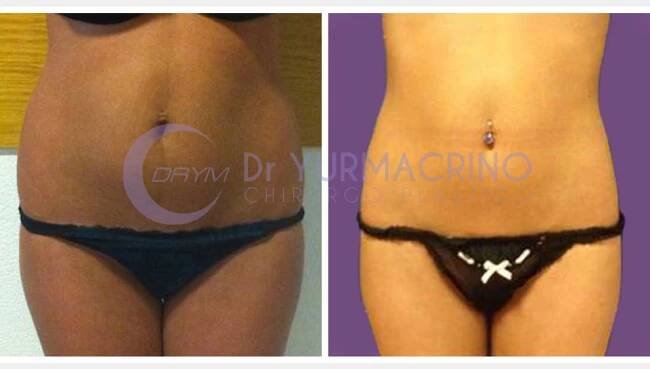 Abdomen/Hips Liposculpture - Dr. Yuri Macrino - Chirurgo Plastico