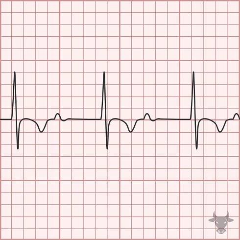 First Degree Atrioventricular Block