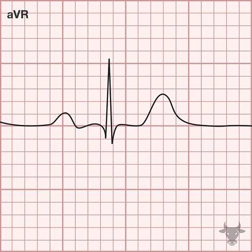 Dextrocardia