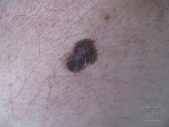 Fotografie kožních chorob | Česká Akademie dermatovenerologie
