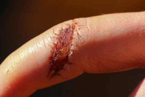First Aid for the Practicing Herbalist-Finger Wound | Northeast School of Botanical Medicine | Northeast School of Botanical