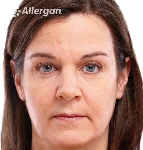 Filler Viso - Dr. Isola