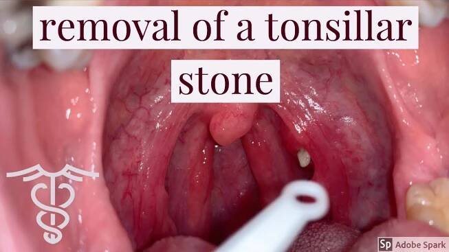 Removal of a tonsillar stone - patient education video by Dr. Carlo Oller