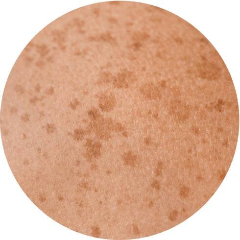 Pigment Behandlung