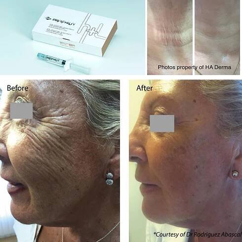 Profilo treatment in poole