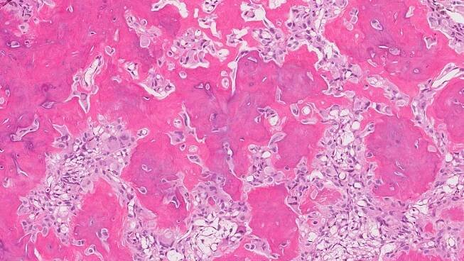 Tento obrázek ukazuje osteoidní osteom pozorovaný pod mikroskopem.
