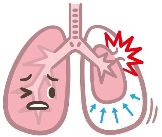 příznaky pneumotoraxového plicního vektoru - cyst phase stock ilustrace