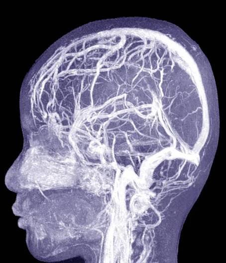 MRI THE BRAIN.Středně pravidelný vazogenní edém s posunem o 0,7 cm na levou stranu.. — Stock obrázek