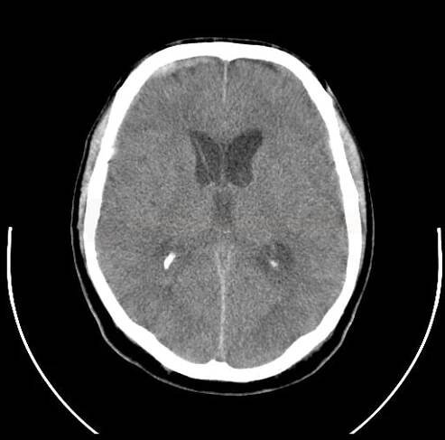 Diagnostika mozkových aneuryzmat | Cerebrovaskulární manuál