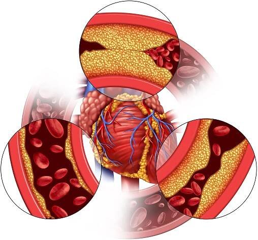 Heart Attack Prevention
