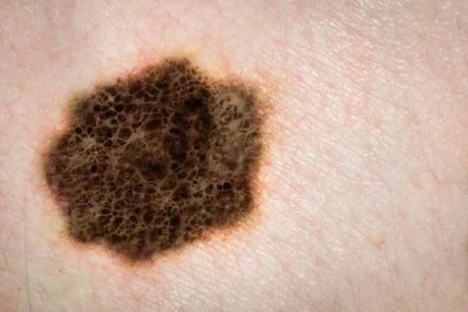 Rakovina kůže melanom