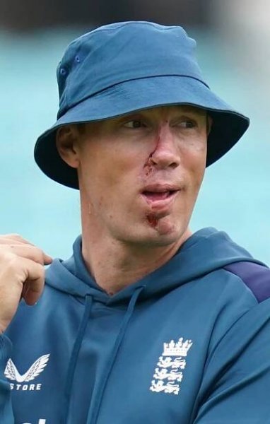 Andrew Flintoff with a facial injury at a cricket nets session.