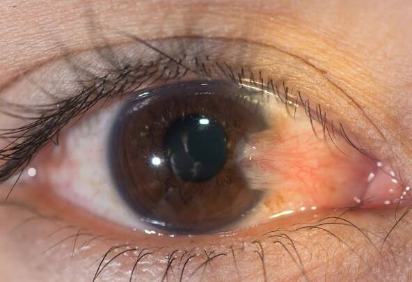 Nasal pterygium on the nasal aspect of right eye