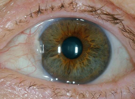 Pterygium conjunctivae – Wikipedia