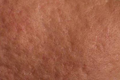 Kůže s akné jizvy — Stock obrázek