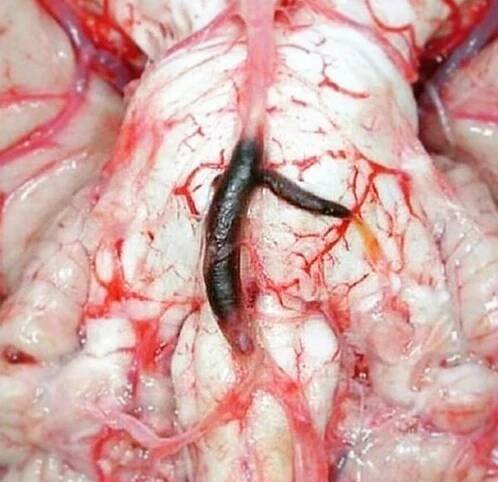 basilar artery