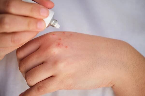 8 Causes of Hand Rash and How to Ease Symptoms