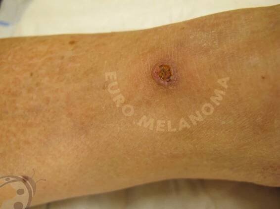 keratoacanthoma 2852