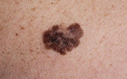 melanom - maligní nádor kůže - melanom - stock snímky, obrázky a fotky