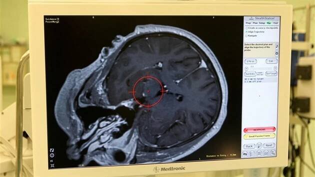 Proti Parkinsonově chorobě bojují olomoučtí chirurgové unikátní operací, při které pacientovi za plného vědomí voperují do mozku elektrody. Pomohou tak zmírnit příznaky, na které již léky nestačí. (23. ledna 2014)