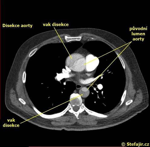 Nález - 37 - Disekce aorty | Medicína, nemoci, studium na 1. LF UK