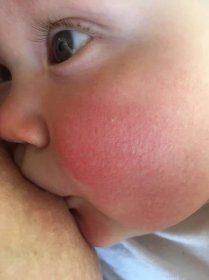 Červená skvrna na tváři čtyřměsíčního miminka. Máte zkušenost? - Modrý koník