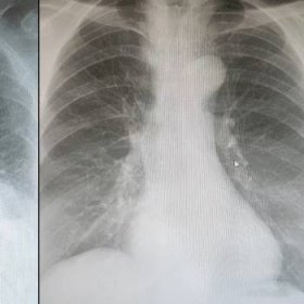 Snímek vlevo znázorňuje postižené plíce po úklidu. Vpravo snímek normálních plic, nejedná se o stejné pacienty. 