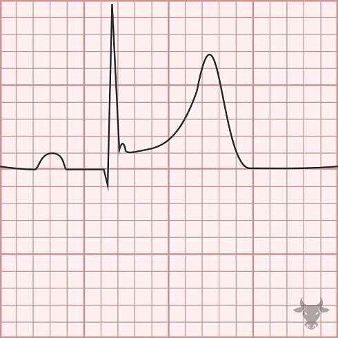 Early Repolarization