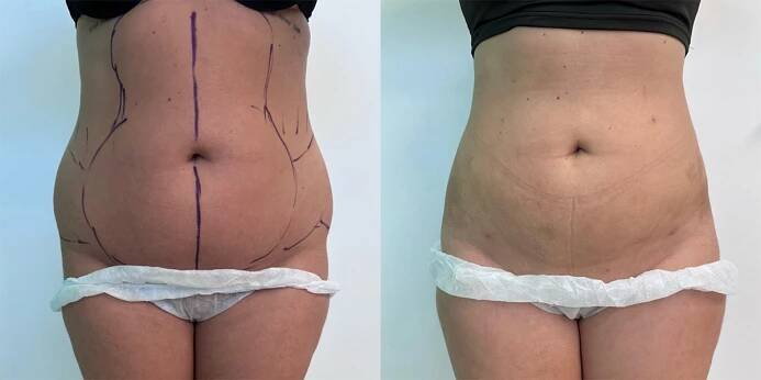 Tumescentní liposukce břicha a boků - šetrné odstranění tuku | CBP Klinika