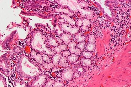 Chronická cholecystitida – WikiSkripta