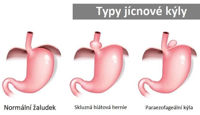 Jícnová kýla (hiátová hernie) - ilustrace