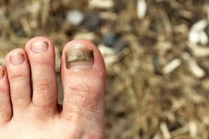 Close Up chlupatý lidské nohy a prsty s popraskané a černé pohmožděný toe nehty na největší prst — Stock obrázek