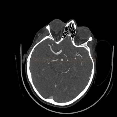 CT angiografie (CTA) | Cerebrovaskulární manuál