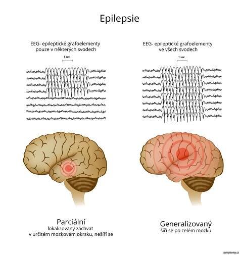 Epilepsie - příznaky a léčba