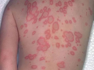Erythema: causes, symptoms and treatment