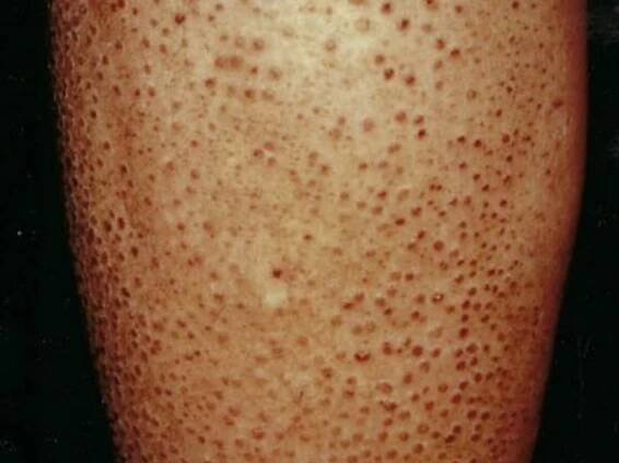 Lichen amyloidosis