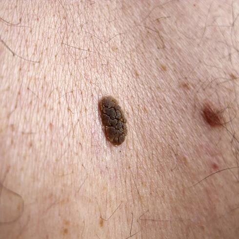 Seborrhoeic Keratosis
