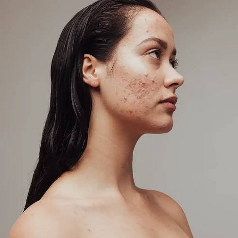 Acne