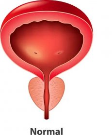 Rozdíl mezi zdravou prostatou a prostatou, u níž se projevuje prostatitida
