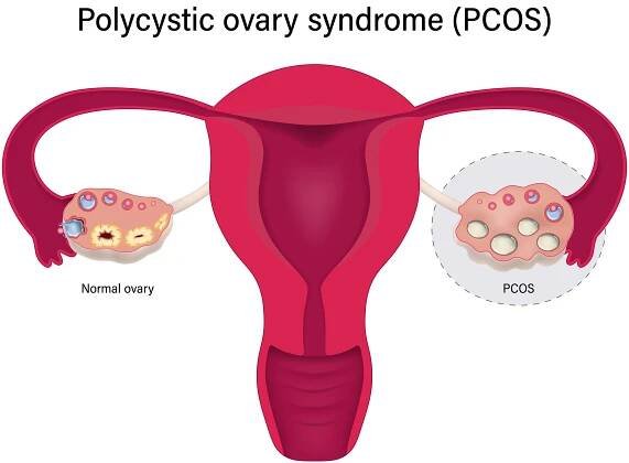 syndrom polycystických vaječníků pcos. více nezralých folikulů vektor. ovariální cysty s ženským reprodukčním systémem. - ovulace stock ilustrace