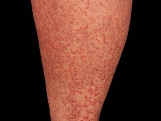 Vasculitis leukocytoclastic (non-iga-associated)
