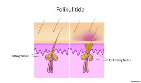 Folikulitida - zánět vlasového váčku
