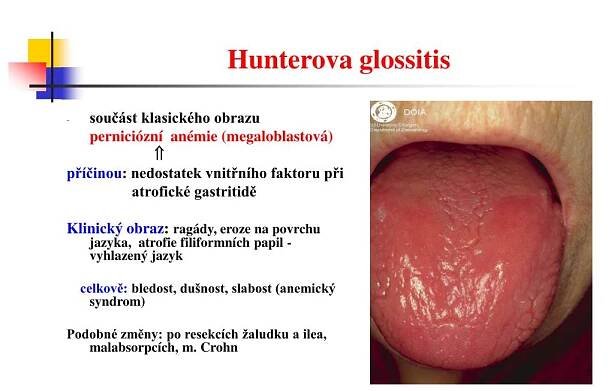 PPT - Nemoci dutiny ústní PowerPoint Presentation, free download - ID:489608
