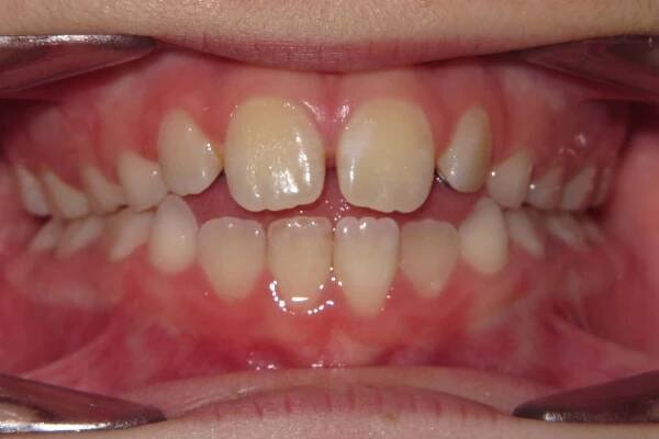 Pediatric Dentistry Smile Gallery - Raber Dental, Kidron Dentist