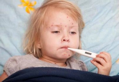 teplota s plané neštovice u dětí