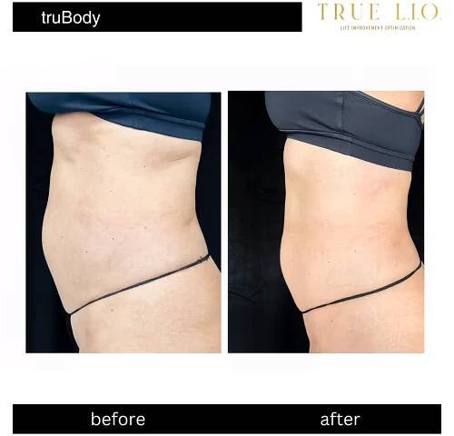 before and after photo result of body sculpting