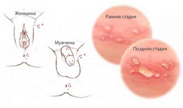 Jak se přenáší genitální herpes? / Venerologie | Užitečné informace a tipy na péči o sebe. Zdraví, výživa a další.